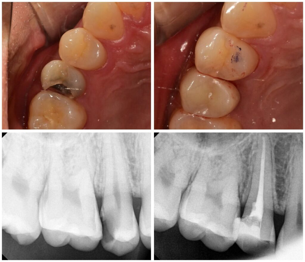 root canal