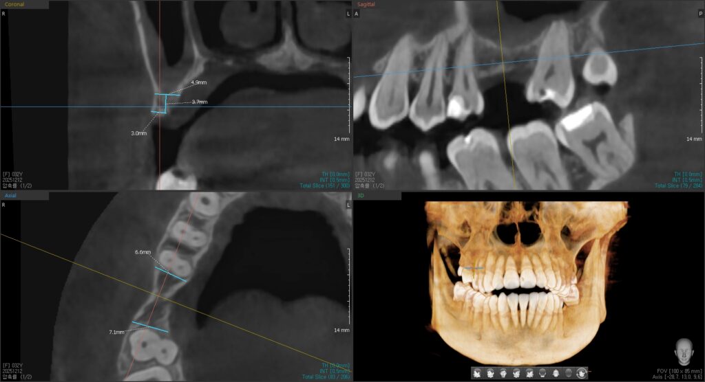 Pre-treatment 3D CT cross-section showing ridge width narrowing from 4.9mm at top to 3.0mm lower down