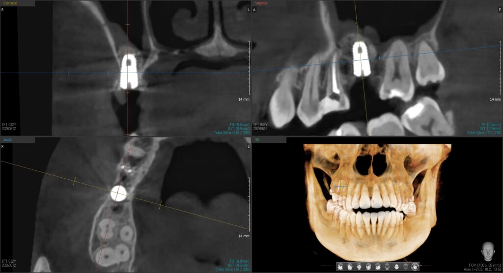 CT cross-section showing the implant placed after ridge split widening and sinus lift
