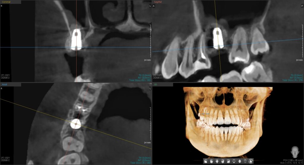 CT cross-section showing bone graft and barrier membrane applied to the cheek-side of the implant