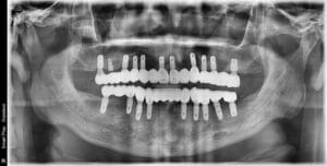 Dental panoramic X-ray of an adult with both jaws restored by full-arch implant-supported fixed prostheses, showing multiple implants in the upper and lower jaws with fixed bridges in occlusion.