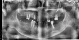 Dental panoramic X-ray of an adult with multiple missing molars, showing remaining teeth, an implant, and empty tooth-loss spaces in both jaws.